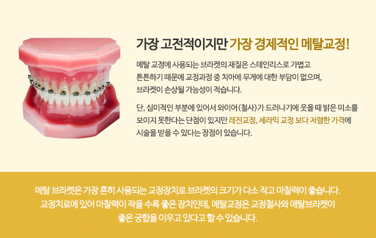 가장 경제적인 메탈교정 이미지